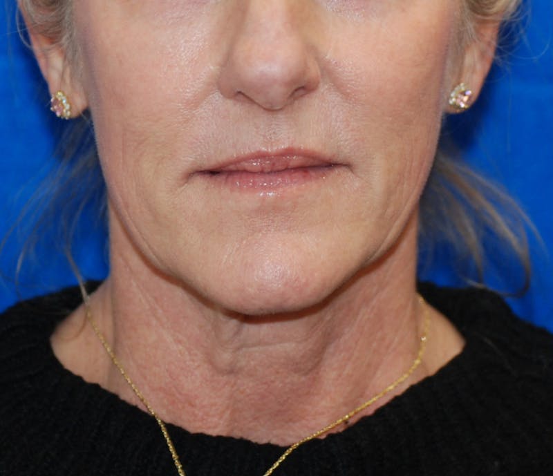 Facelift Before & After Gallery - Patient 324704 - Image 5