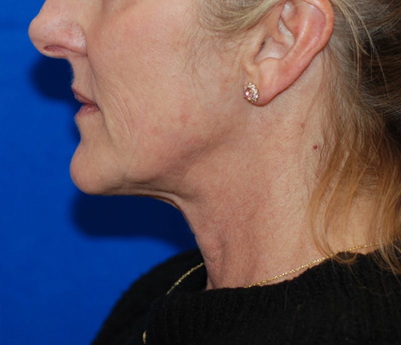 Facelift Before & After Gallery - Patient 324704 - Image 3