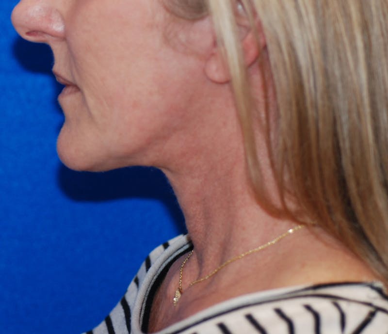 Facelift Before & After Gallery - Patient 324704 - Image 4