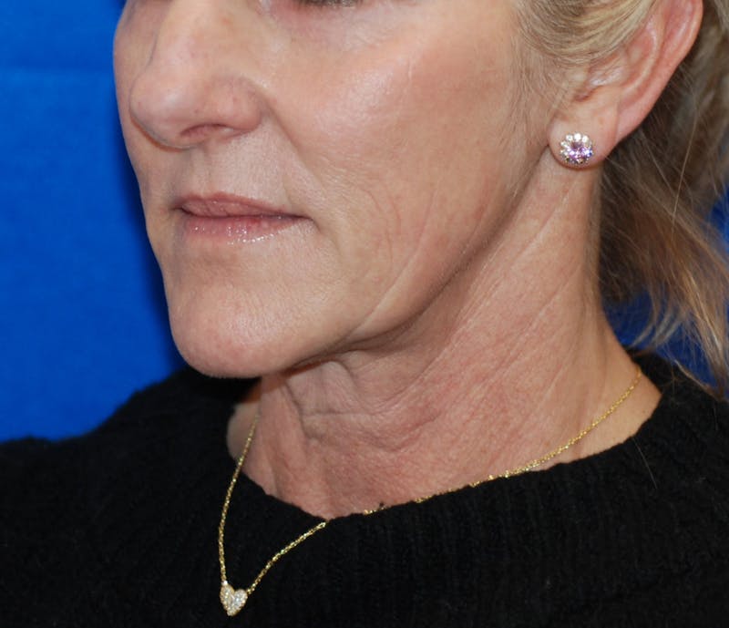 Facelift Before & After Gallery - Patient 324704 - Image 1
