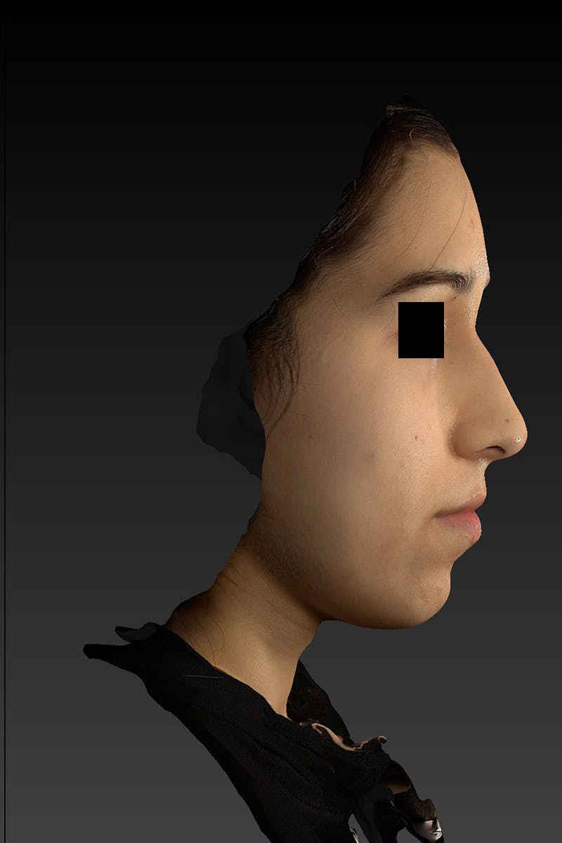 Liquid Rhinoplasty Before & After Gallery - Patient 202099 - Image 4