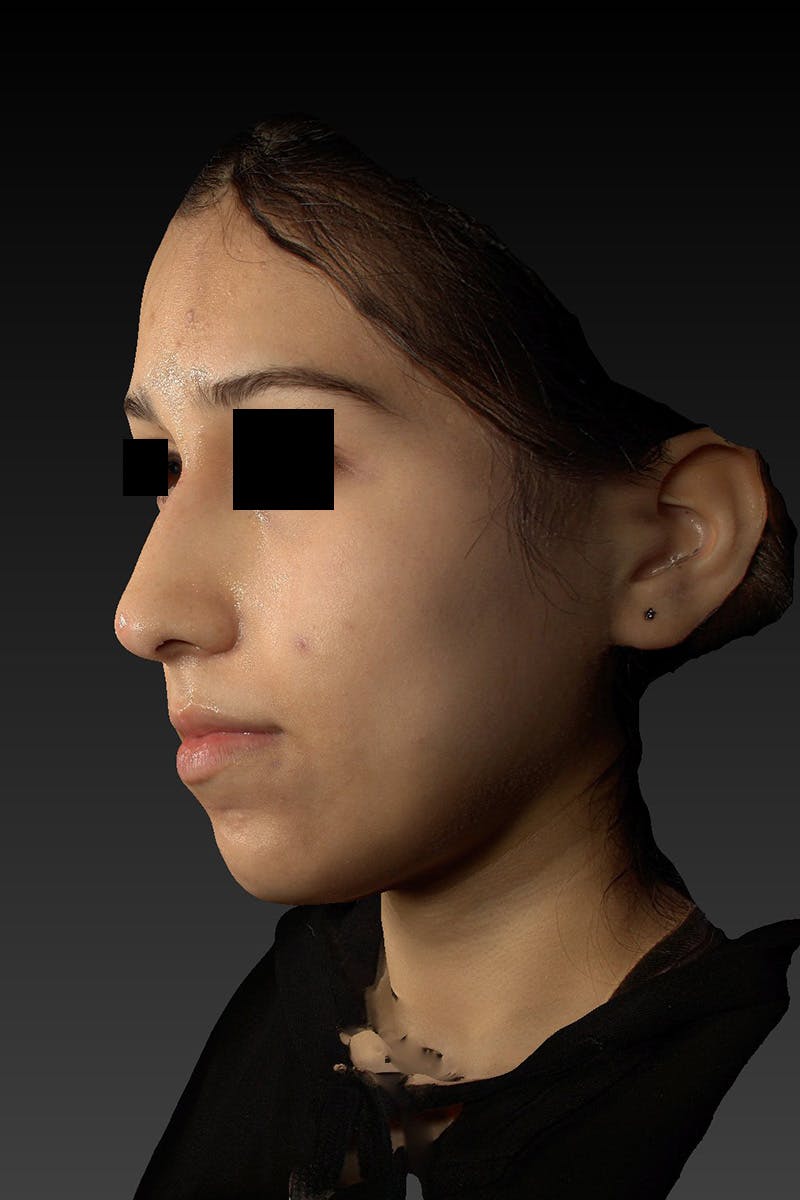Liquid Rhinoplasty Before & After Gallery - Patient 202099 - Image 6
