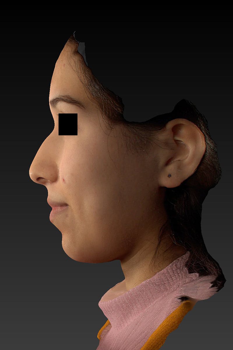 Liquid Rhinoplasty Before & After Gallery - Patient 202099 - Image 7