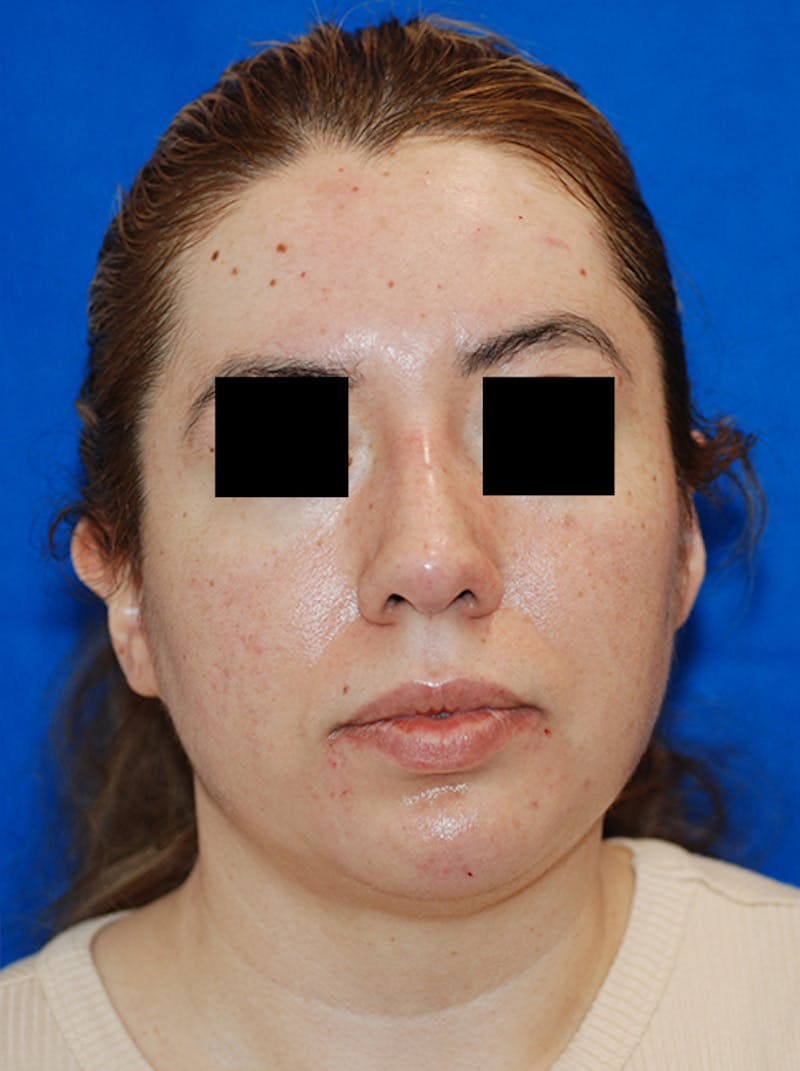 Liquid Rhinoplasty Before & After Gallery - Patient 205007 - Image 6