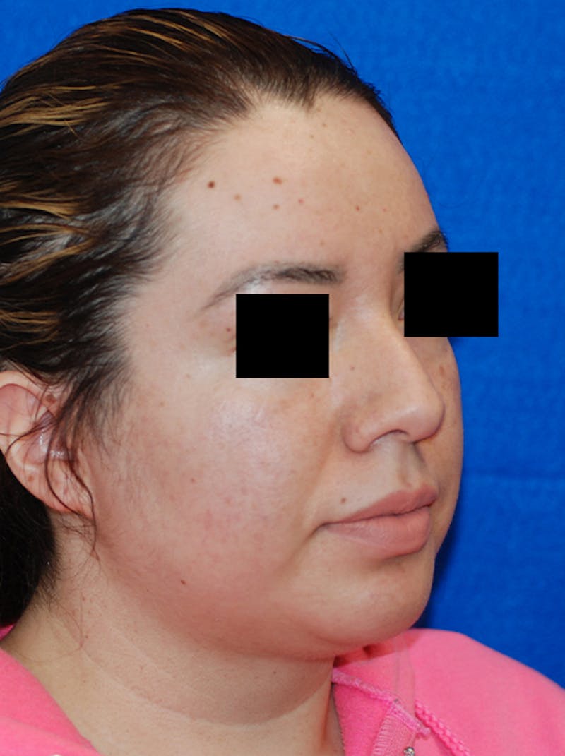 Liquid Rhinoplasty Before & After Gallery - Patient 205007 - Image 3