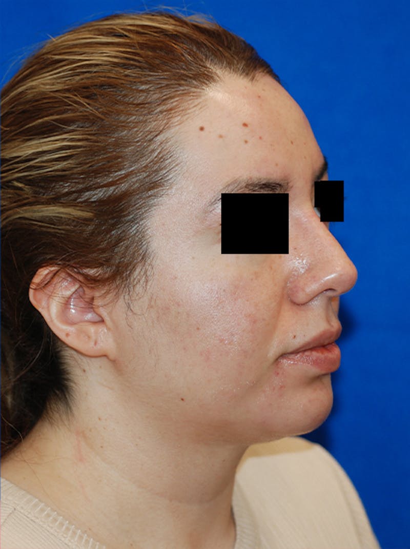 Liquid Rhinoplasty Before & After Gallery - Patient 205007 - Image 4