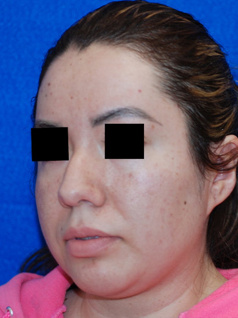 Liquid Rhinoplasty Before & After Gallery - Patient 205007 - Image 7