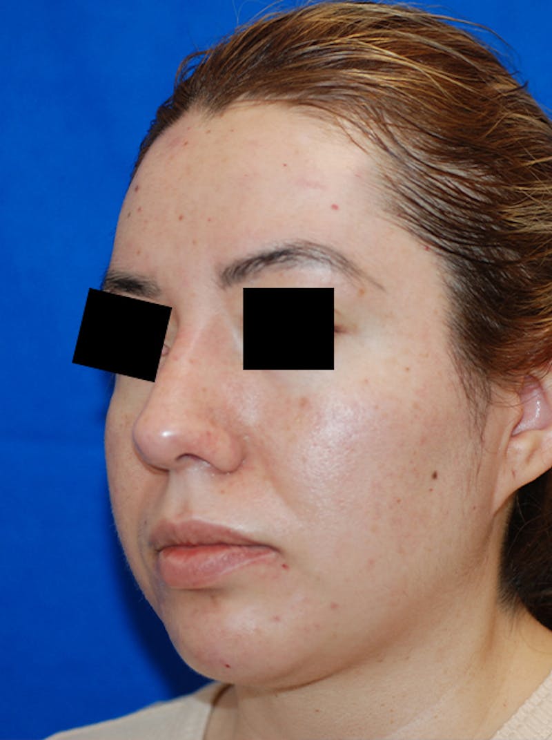 Liquid Rhinoplasty Before & After Gallery - Patient 205007 - Image 8
