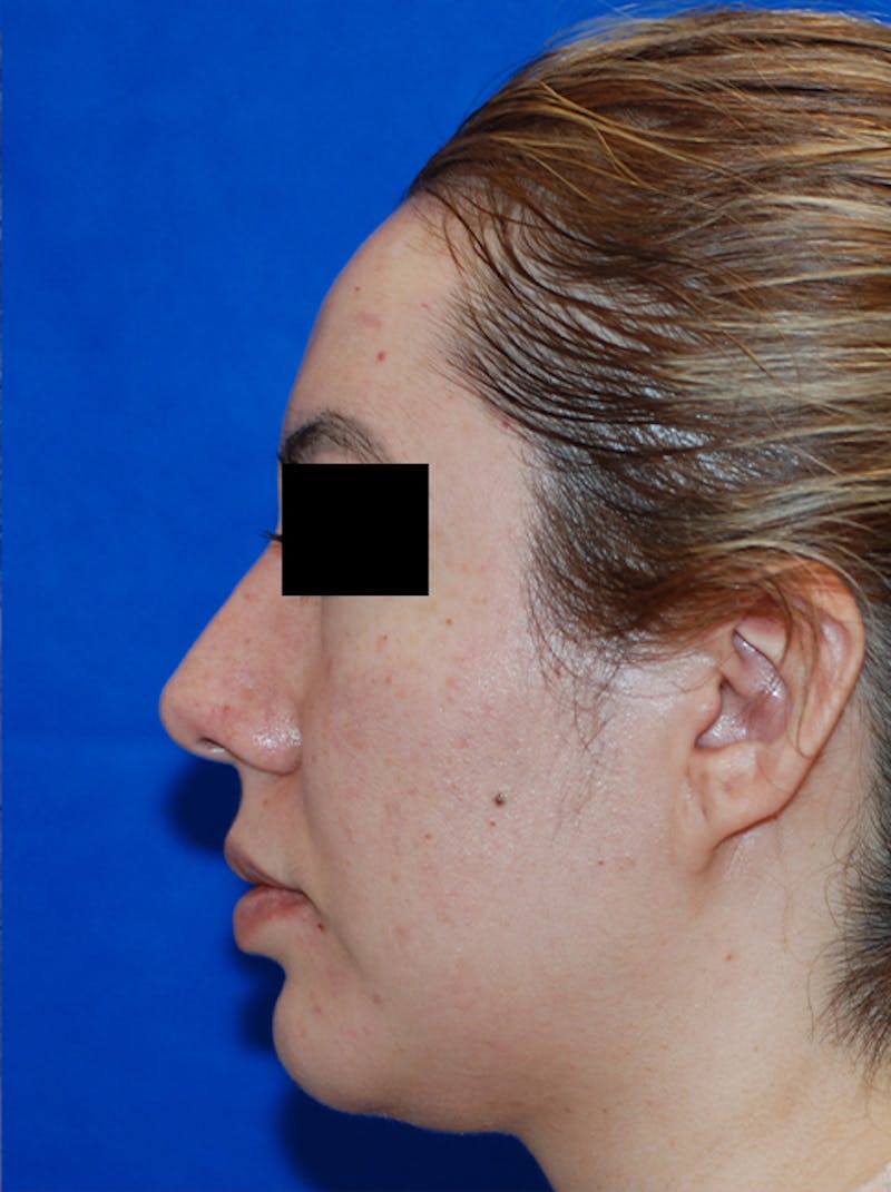 Liquid Rhinoplasty Before & After Gallery - Patient 205007 - Image 10