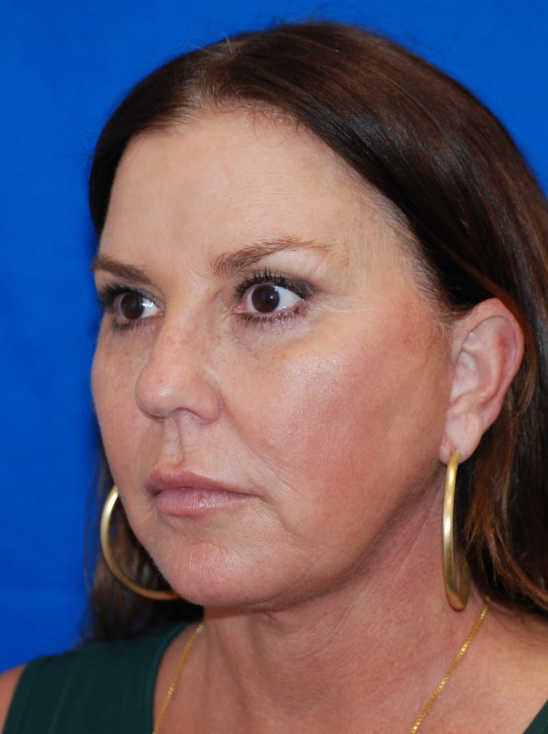 Facelift Before & After Gallery - Patient 607152 - Image 10
