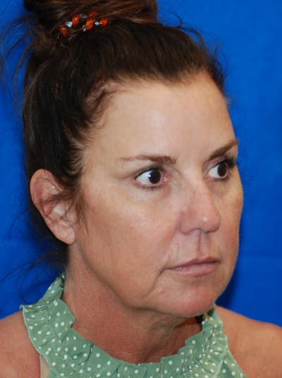 Facelift Before & After Gallery - Patient 607152 - Image 1