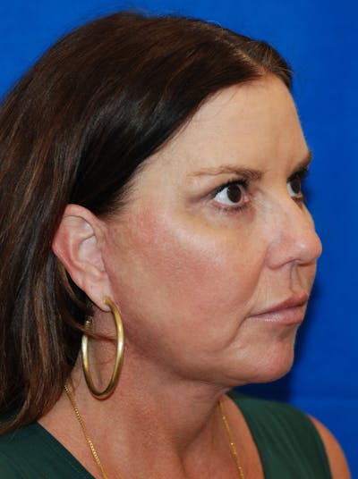 Facelift Before & After Gallery - Patient 607152 - Image 2