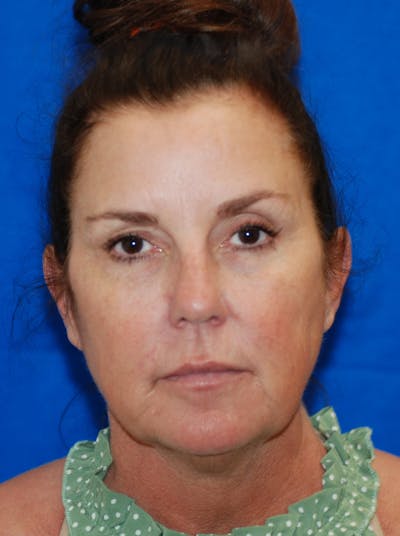 Eyelid Surgery Before & After Gallery - Patient 369971 - Image 1