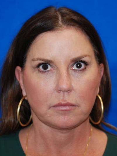 Eyelid Surgery Before & After Gallery - Patient 369971 - Image 2
