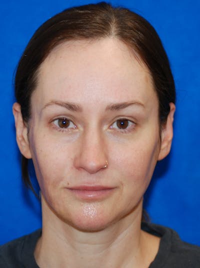 Dermal Fillers Before & After Gallery - Patient 320283 - Image 2