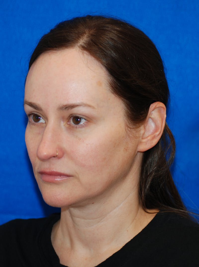 Dermal Fillers Before & After Gallery - Patient 320283 - Image 3