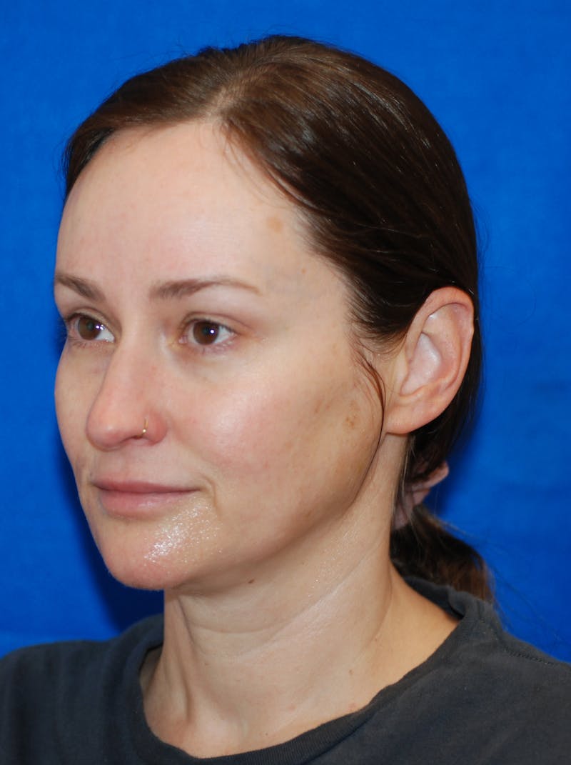 Dermal Fillers Before & After Gallery - Patient 320283 - Image 4