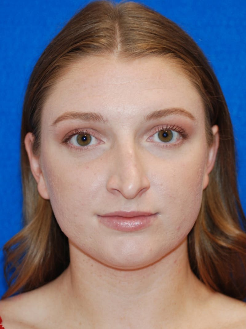 Rhinoplasty Before & After Gallery - Patient 405123 - Image 5