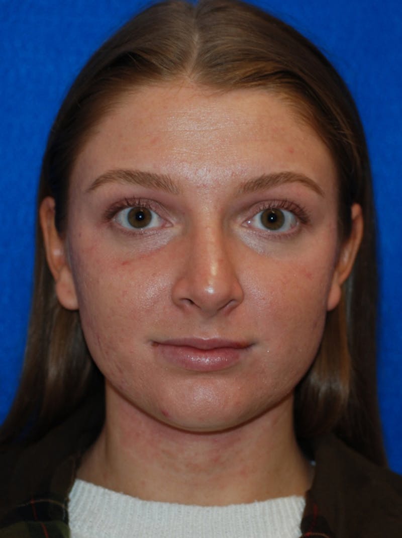 Rhinoplasty Before & After Gallery - Patient 405123 - Image 6
