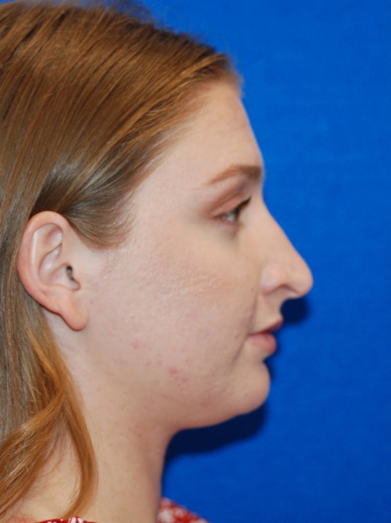 Rhinoplasty Before & After Gallery - Patient 405123 - Image 7