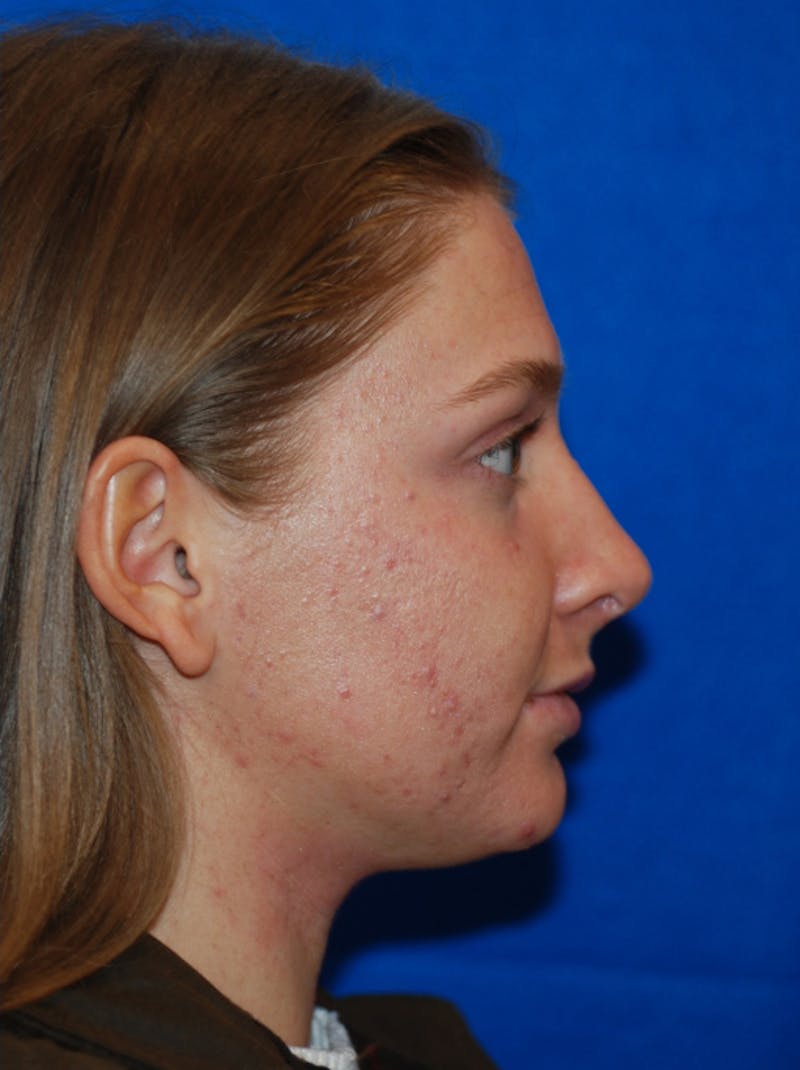 Rhinoplasty Before & After Gallery - Patient 405123 - Image 8