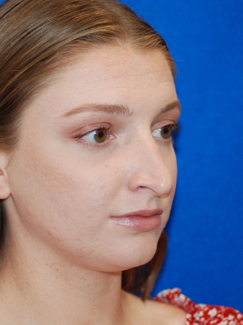 Rhinoplasty Before & After Gallery - Patient 405123 - Image 9