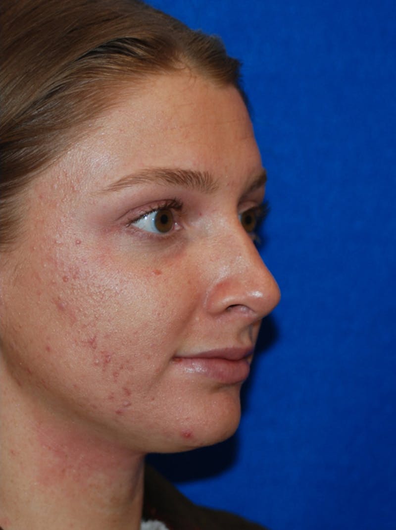 Rhinoplasty Before & After Gallery - Patient 405123 - Image 10