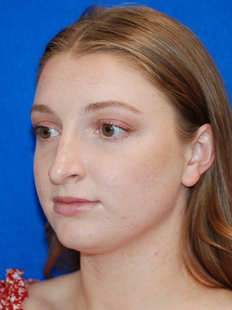 Rhinoplasty Before & After Gallery - Patient 405123 - Image 1