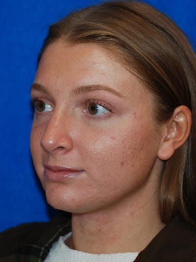 Rhinoplasty Before & After Gallery - Patient 405123 - Image 2