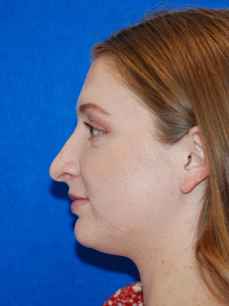 Rhinoplasty Before & After Gallery - Patient 405123 - Image 3