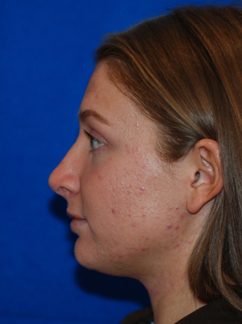 Rhinoplasty Before & After Gallery - Patient 405123 - Image 4