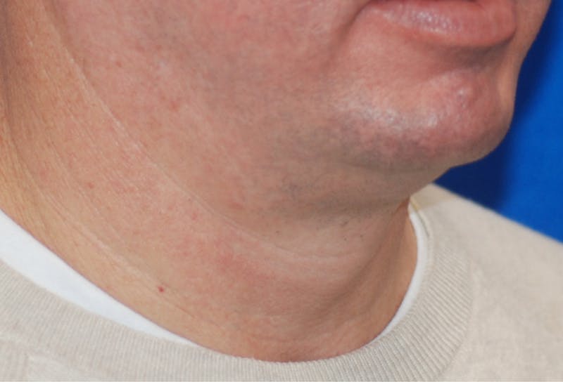 Chin Implant Before & After Gallery - Patient 108401353 - Image 7