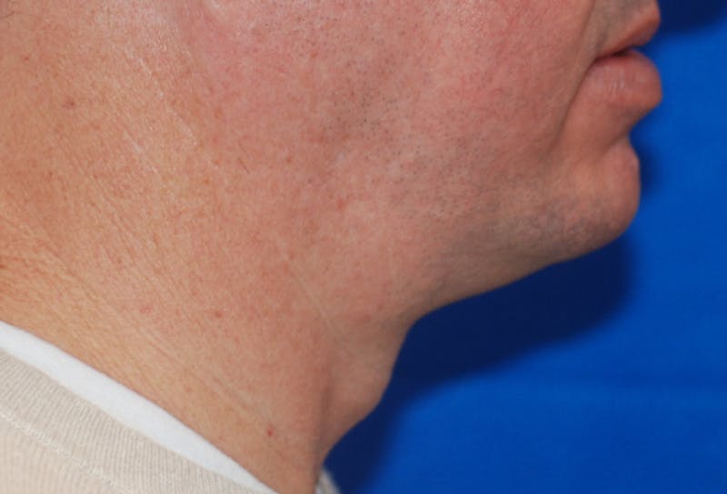 Chin Implant Before & After Gallery - Patient 108401353 - Image 9