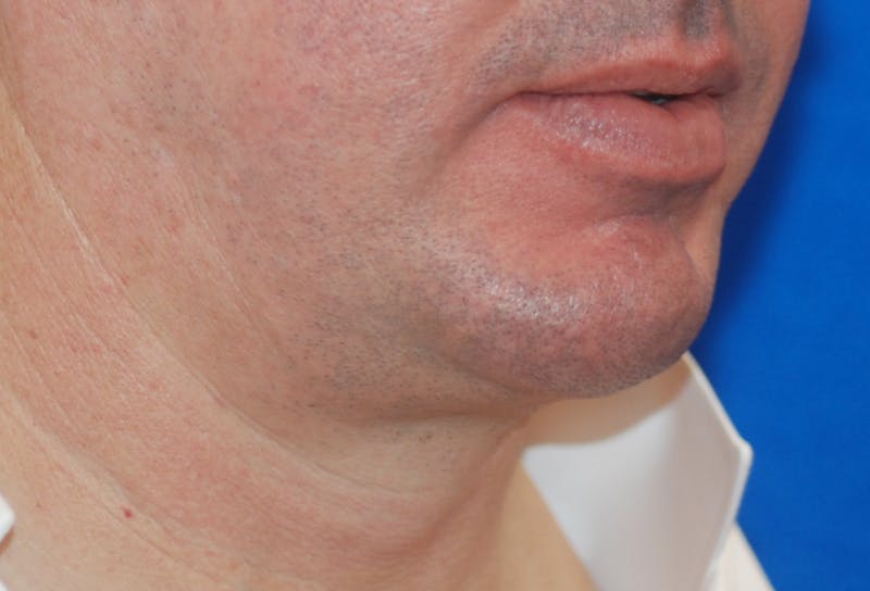 Chin Implant Before & After Gallery - Patient 108401353 - Image 8