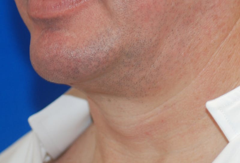 Chin Implant Before & After Gallery - Patient 108401353 - Image 6