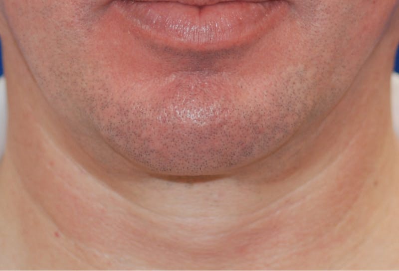 Chin Implant Before & After Gallery - Patient 108401353 - Image 4
