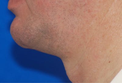 Chin Implant Before & After Gallery - Patient 108401353 - Image 2