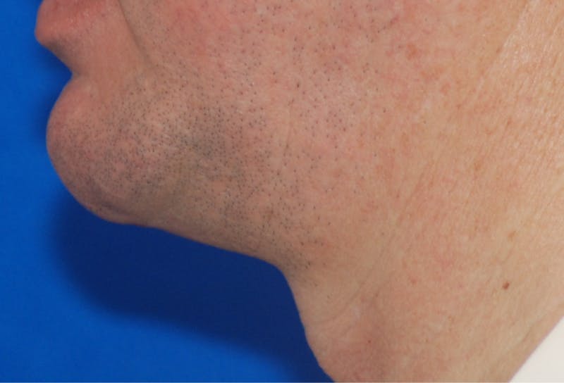 Chin Implant Before & After Gallery - Patient 108401353 - Image 2