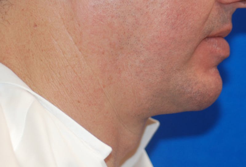 Chin Implant Before & After Gallery - Patient 108401353 - Image 10