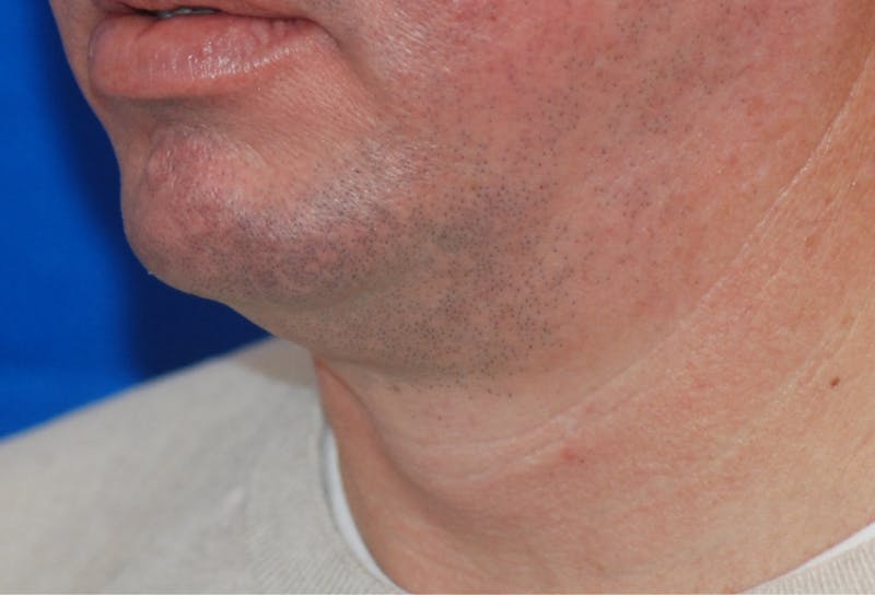 Chin Implant Before & After Gallery - Patient 108401353 - Image 5