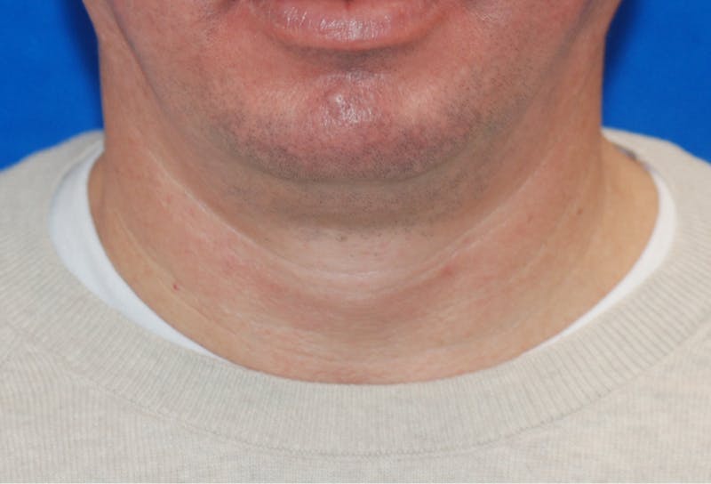 Chin Implant Before & After Gallery - Patient 108401353 - Image 3