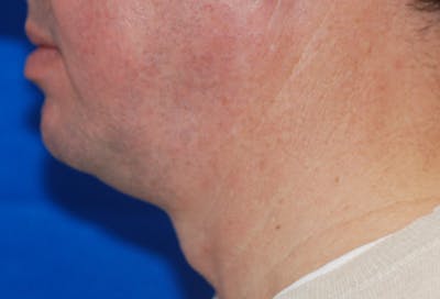 Chin Implant Before & After Gallery - Patient 108401353 - Image 1