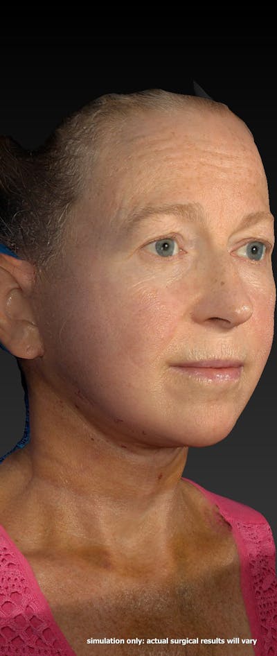 Facelift Before & After Gallery - Patient 218105 - Image 2