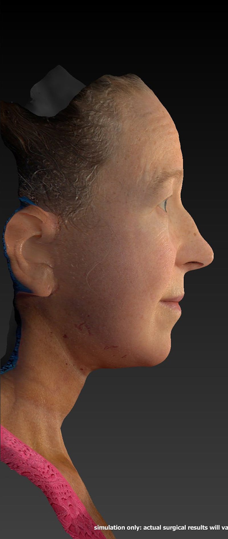 Facelift Before & After Gallery - Patient 218105 - Image 6