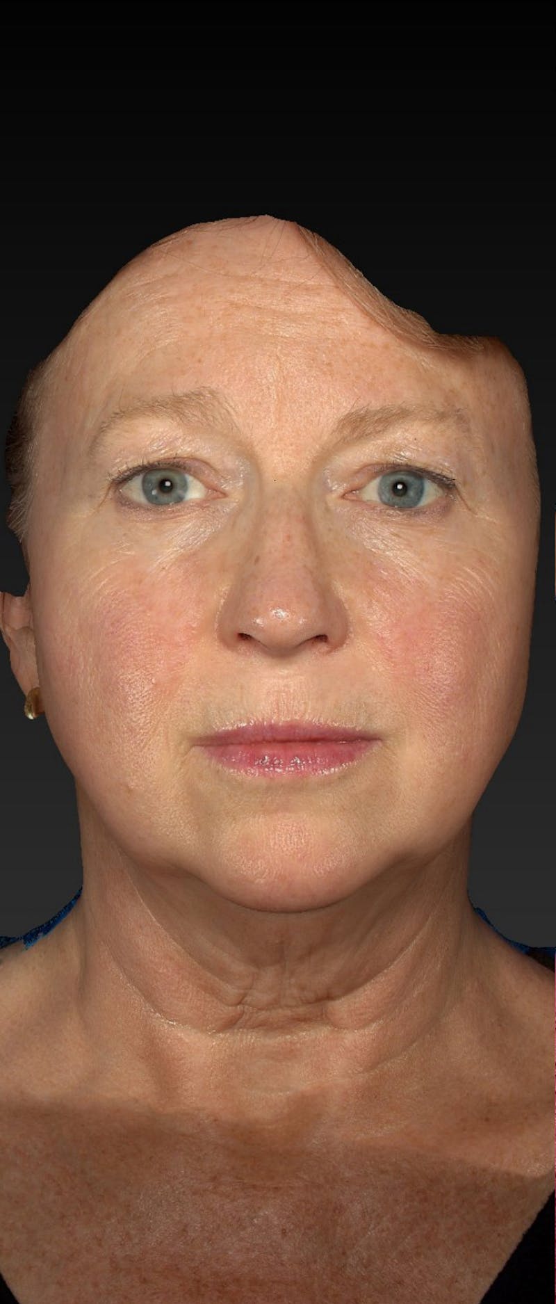 Facelift Before & After Gallery - Patient 218105 - Image 3