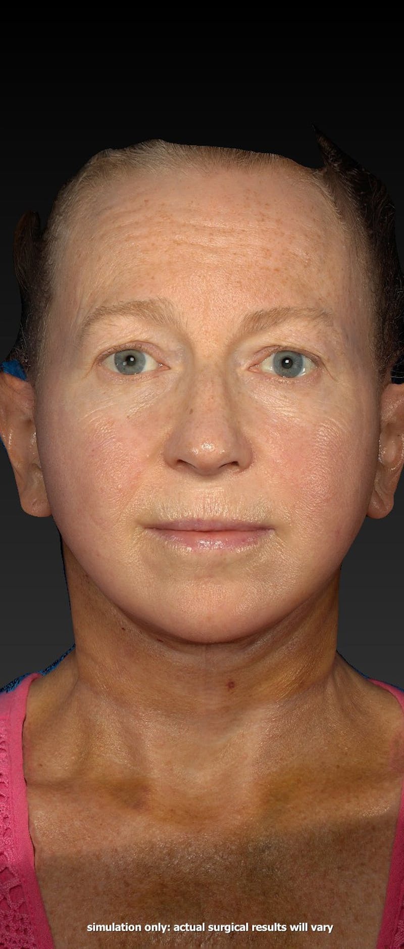 Facelift Before & After Gallery - Patient 218105 - Image 4