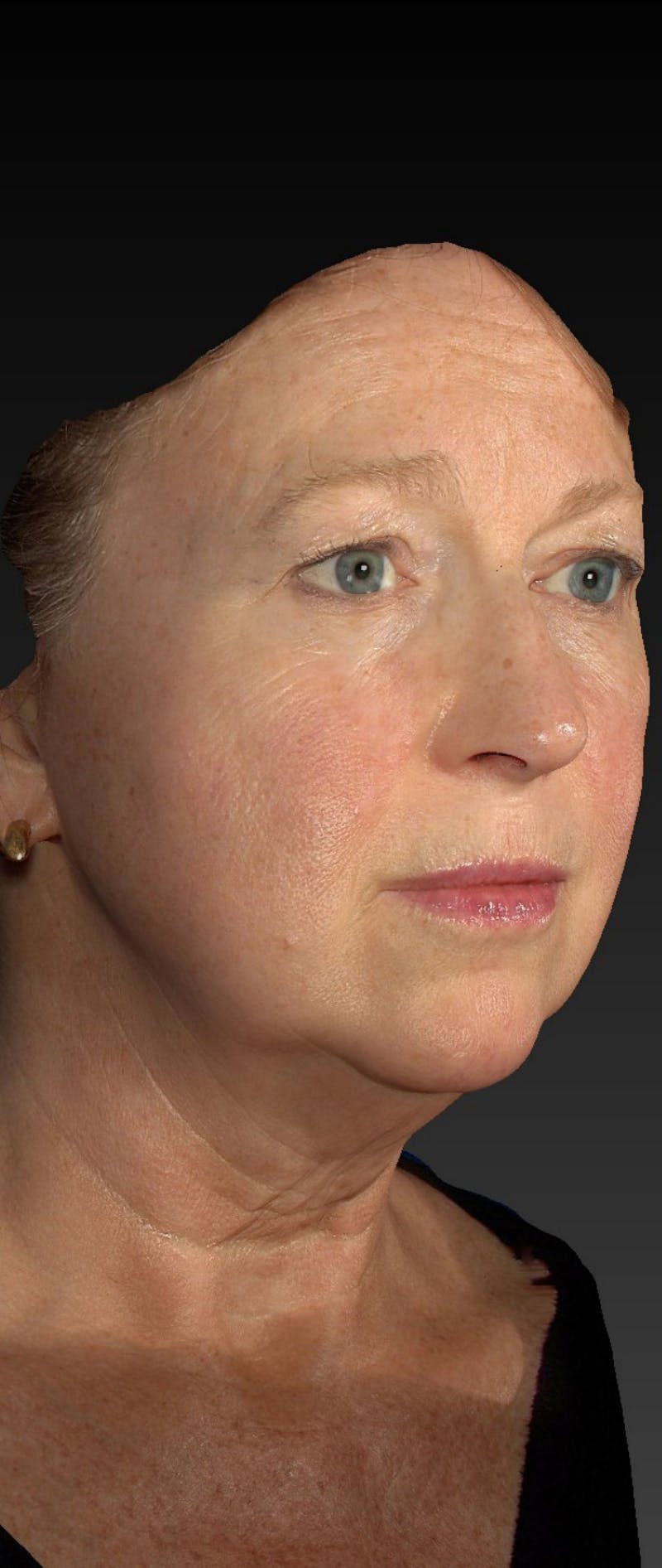 Facelift Before & After Gallery - Patient 218105 - Image 1