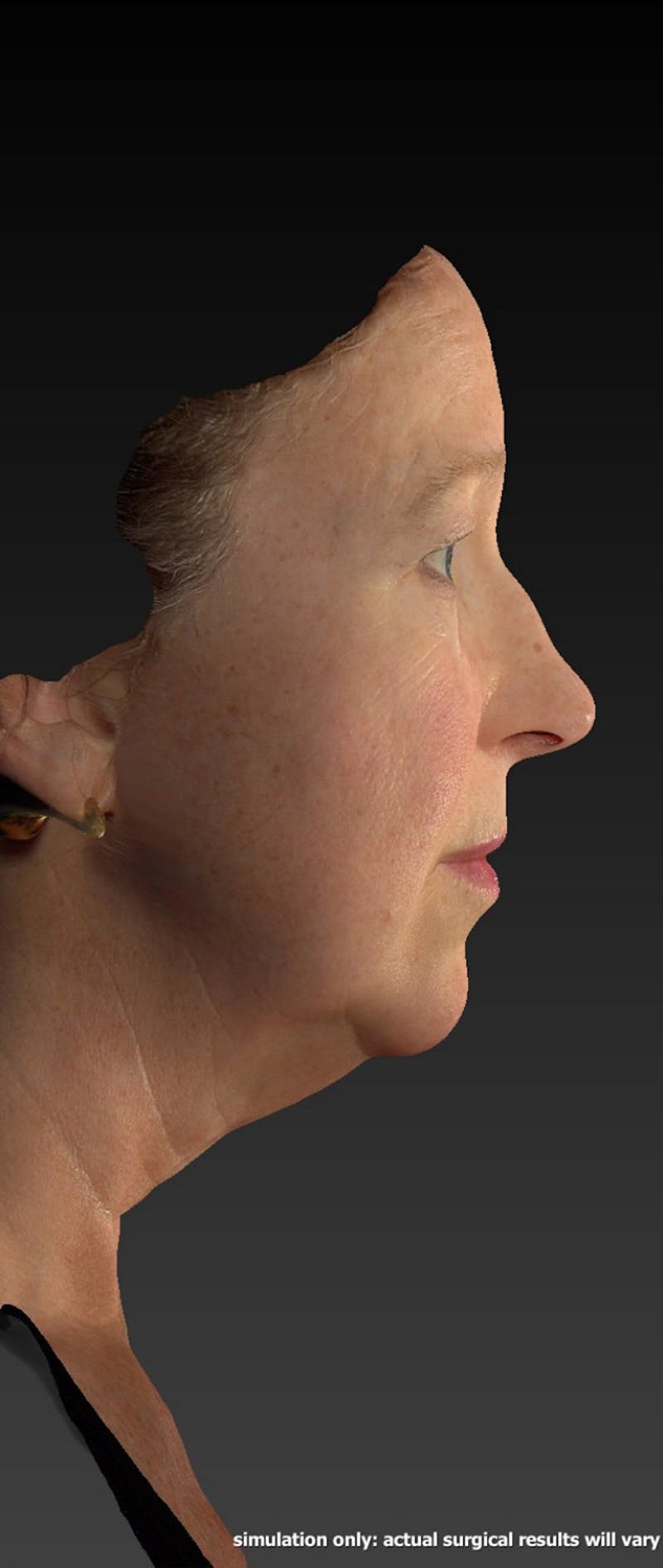 Facelift Before & After Gallery - Patient 218105 - Image 5