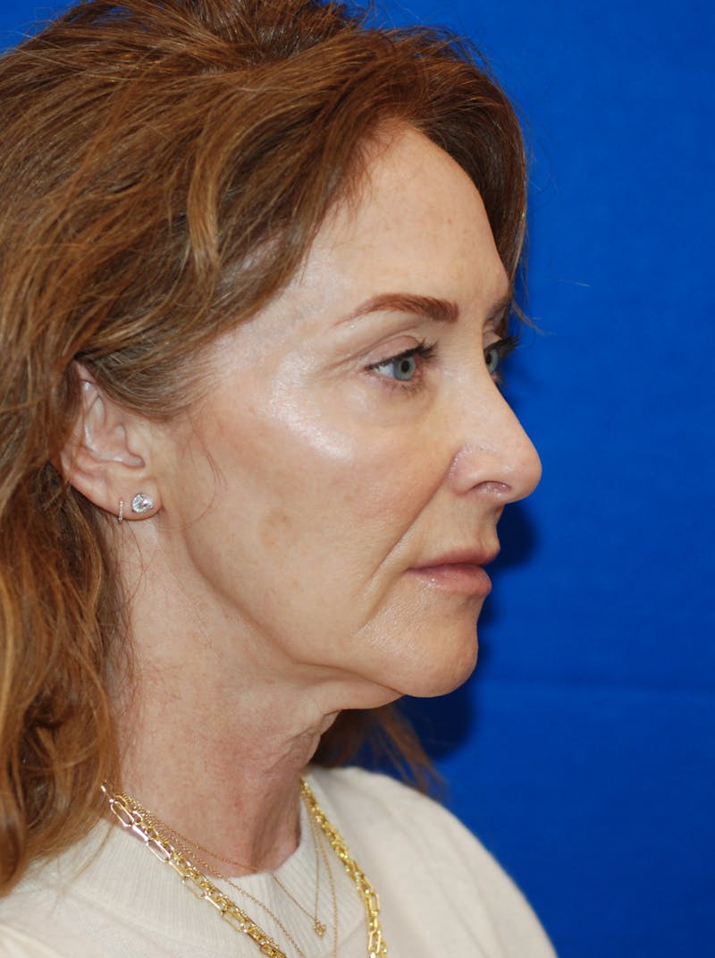 Facelift Before & After Gallery - Patient 994875 - Image 1