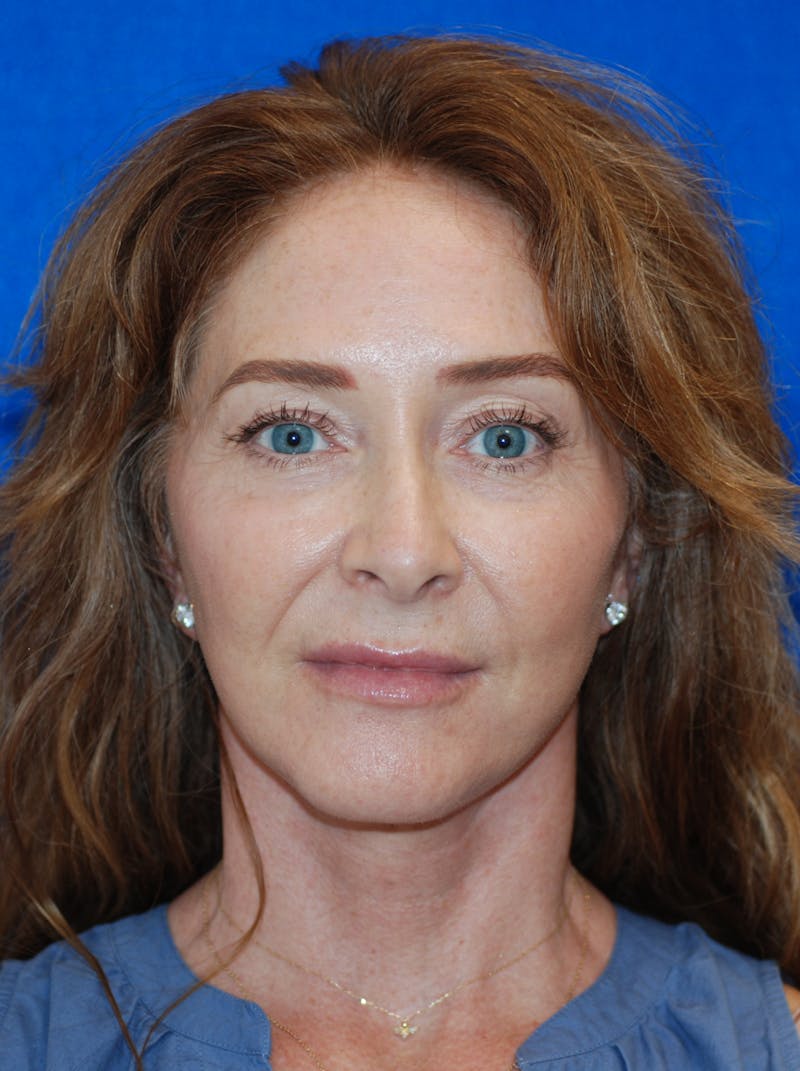 Facelift Before & After Gallery - Patient 994875 - Image 4